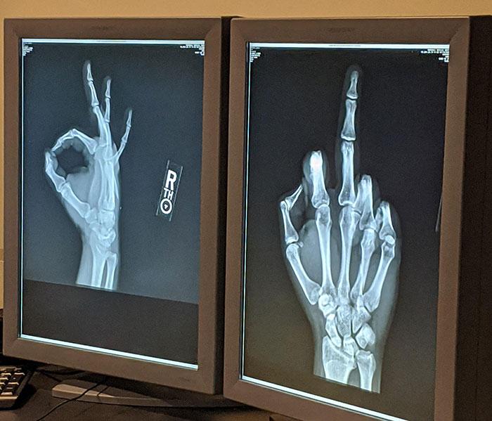 Father In Law Is A Radiologist. Put This In His X-Ray Stack For My Hand