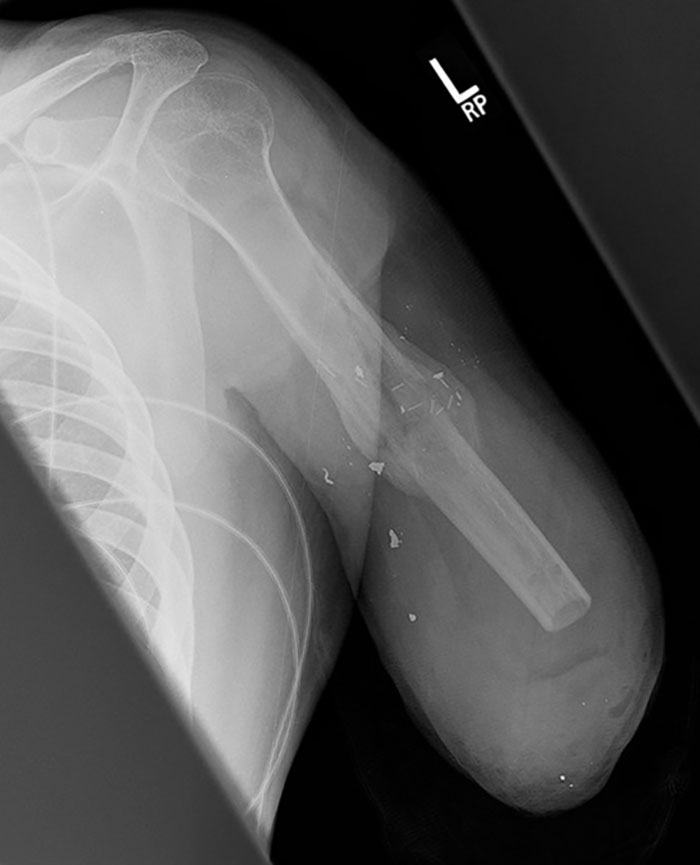 X-Ray Of My Arm After Amputation, Thanks To Driver Who Fell Asleep At The Wheel