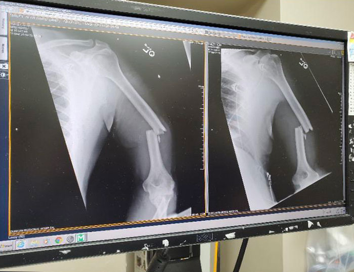 My (Nearly 60-Years-Old) Father's Arm After Being Thwomped By A Cow This Morning