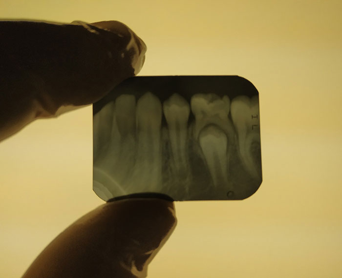 Today I Took A Dental X-Ray For A Child. This Is How The Milk Teeth Change Permanently. The Picture Clearly Shows How The Premolar Comes Out