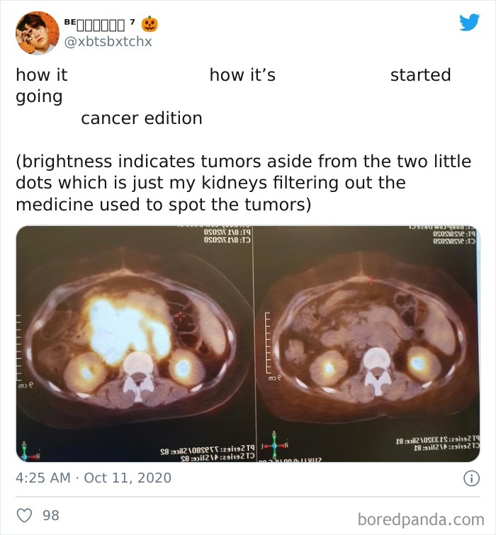 Comparison of cancer scans showing tumor brightness reduction in a how it started vs how it’s going challenge.