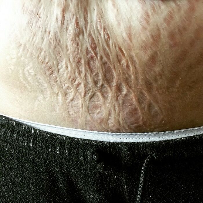 These Stripes Mean I Carried Life Inside Of Me. I'm Not Ashamed