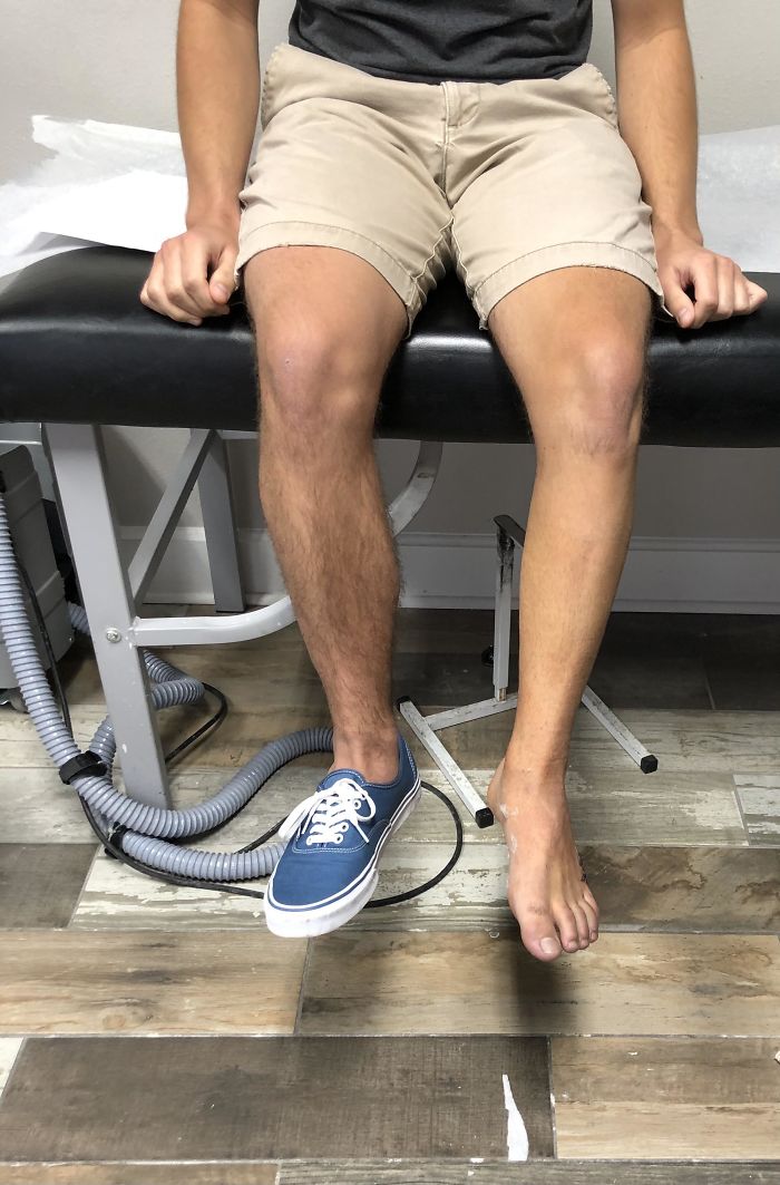 The Difference In My Legs After Being In A Cast For 1 Month