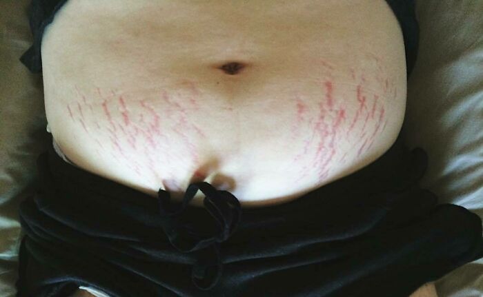 Just Before Giving Birth, At 45lbs Over My Pre-Pregnancy Weight, I Was Pretty Concerned About How I May Feel Towards My Body Post-Partum