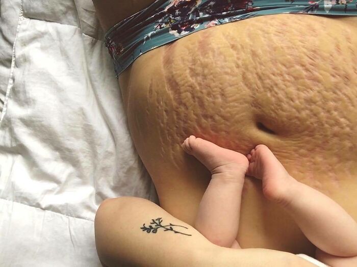 "I May Be A Little Softer But Ultimately I Am Stronger And These Marks Just Remind Me Of Where I Once Tightly Held And Grew Emilia Ren. This Body, Me, I May Not Be The Same But If She Can Find So Much Comfort And Safety In This Body, I Will As Well."