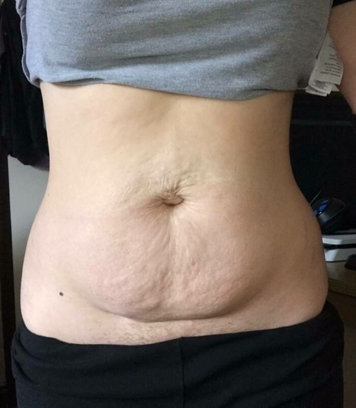 "Mummy Tummy (Yes Women Grow Body Hair Too)"