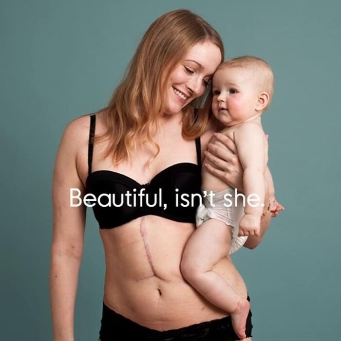 Louise, 29 Weeks After Giving Birth