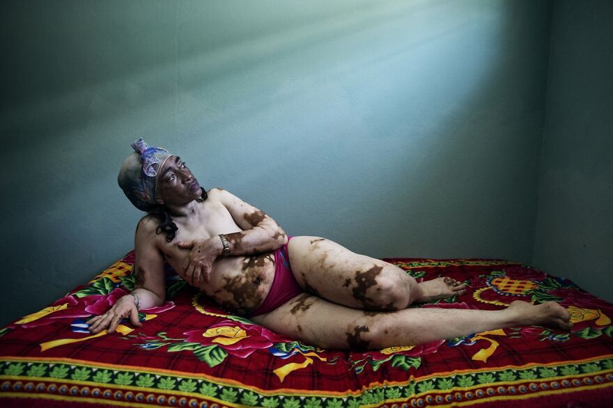 Vitiligo: Mercedes (Remarkable Artwork In Fascinating Faces And Characters Category)