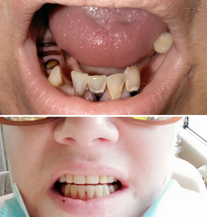 Kind Strangers Randomly Volunteered To Pay For Extensive Dental Work I Needed Done For 2 Years. Today I Was Able To Get It Done