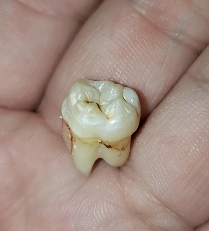 Well, Today I Had My Tooth Removed. But Get This It Was The Wrong Tooth. Just My Luck