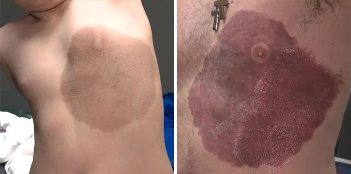 Father with tattoo matching his child's birthmark on their torso.