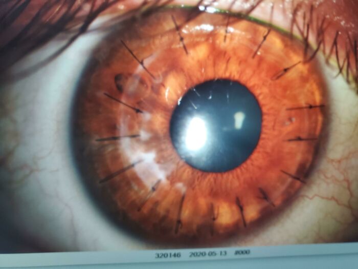 I Had A Cornea Transplant And Have Stitches In My Eye