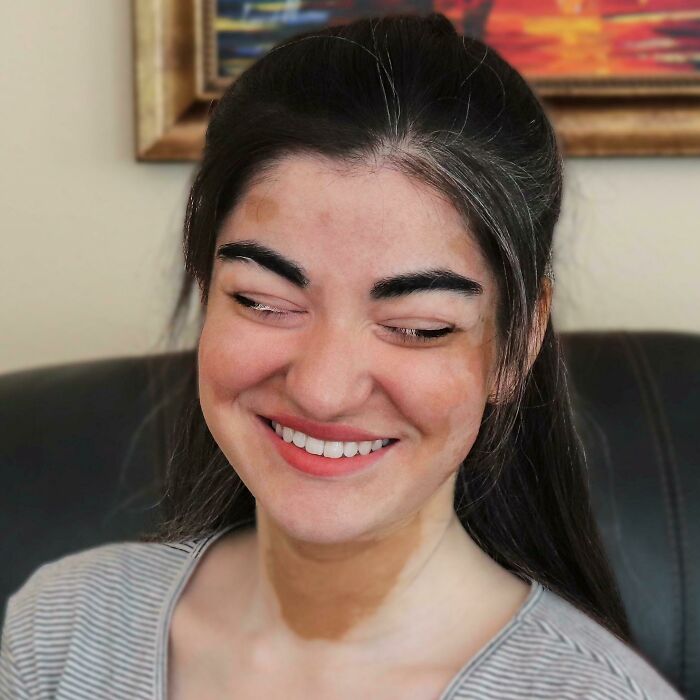My Vitiligo Has Turned Half Of My Upper Eyelashes White