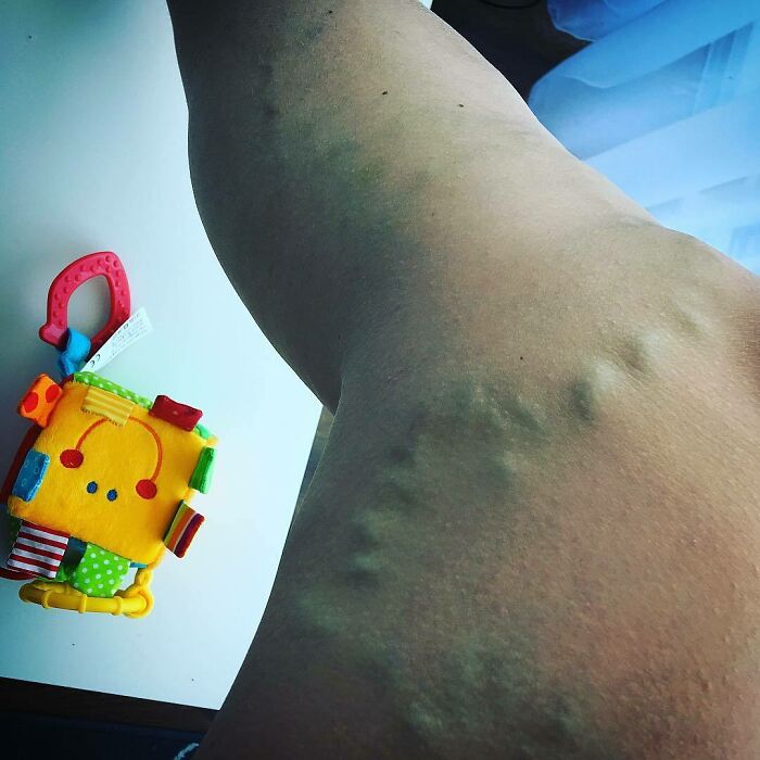 The Veins In Your Legs Can Start To Protrude, It's Called Varicose Veins