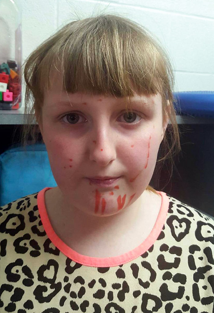 Me When I Was 8, I Thought I Would Ditch School By Drawing “Chickenpox” On My Face With Red Marker