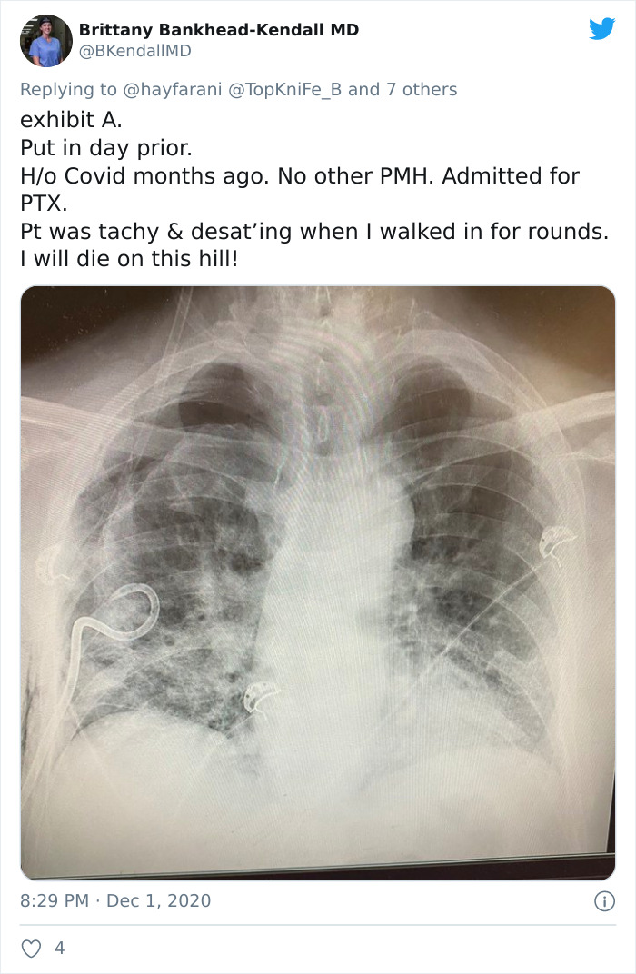 X-Ray Shows The Effect Of COVID-19 On The Lungs Compared To A Smoker's Lungs X-Ray Shows The Effect Of COVID-19 On The Lungs Compared To A Smoker's Lungs