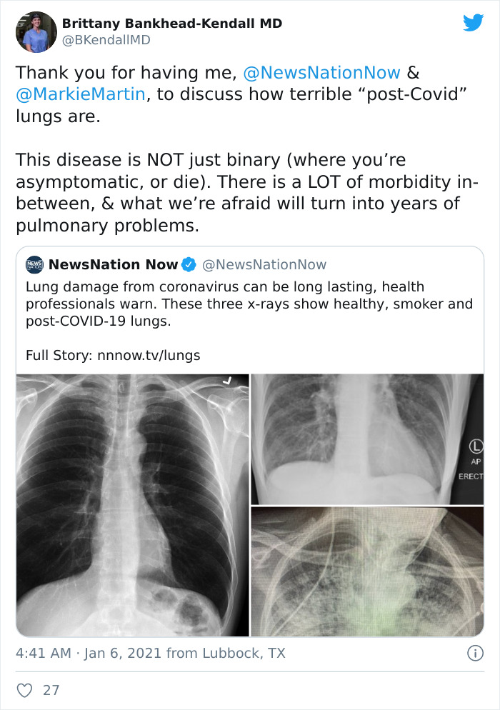 X-Ray Shows The Effect Of COVID-19 On The Lungs Compared To A Smoker's Lungs X-Ray Shows The Effect Of COVID-19 On The Lungs Compared To A Smoker's Lungs