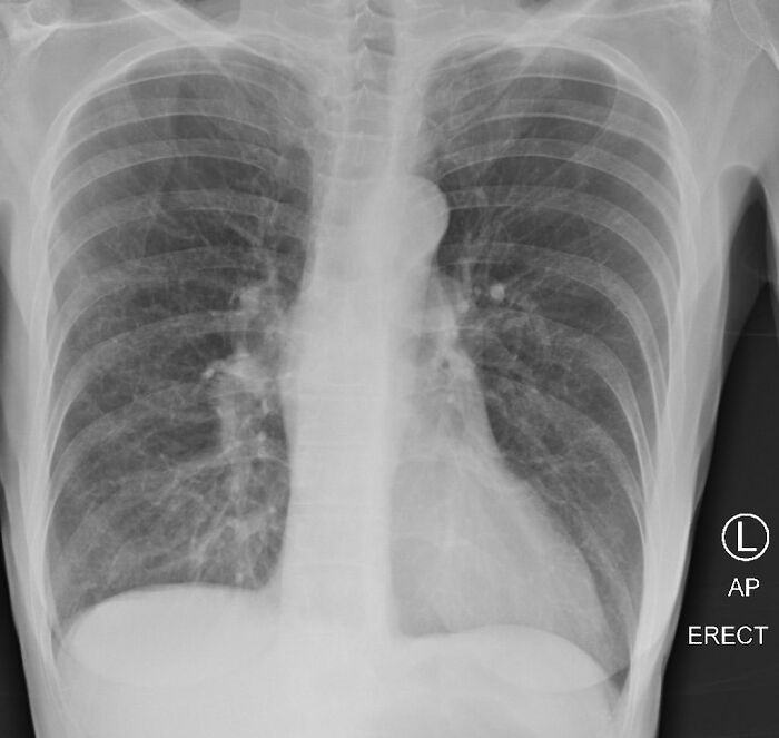 X-Ray Shows The Effect Of COVID-19 On The Lungs Compared To A Smoker's Lungs X-Ray Shows The Effect Of COVID-19 On The Lungs Compared To A Smoker's Lungs