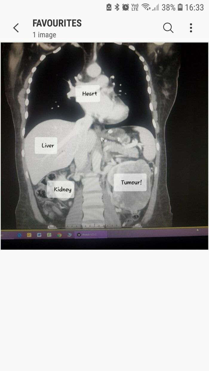 My Doctor Told Me It Was Heartburn For 8 Months, Cancerous Tumour Encapsulated The Kidney, When Removed It Was The Size Of A Honey Dew Melon And Hadn't Spread - Oncologist Couldn't Believe It. Nearly 6 Years Cancer Free 😊