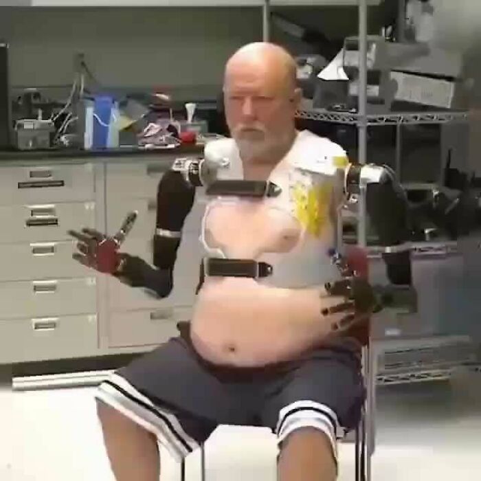 American Forest Bof Lost Both Hands In A Car Accident 40 Years Ago. When He Was Offered An Experimental Operation, He Decided Not To Refuse