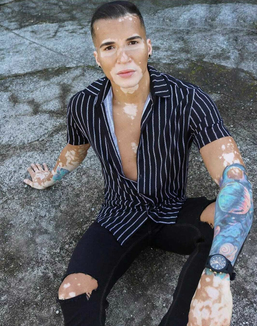 After Battling Depression For A Decade, This Brazilian Model With Vitiligo Learnt To Accept Himself
