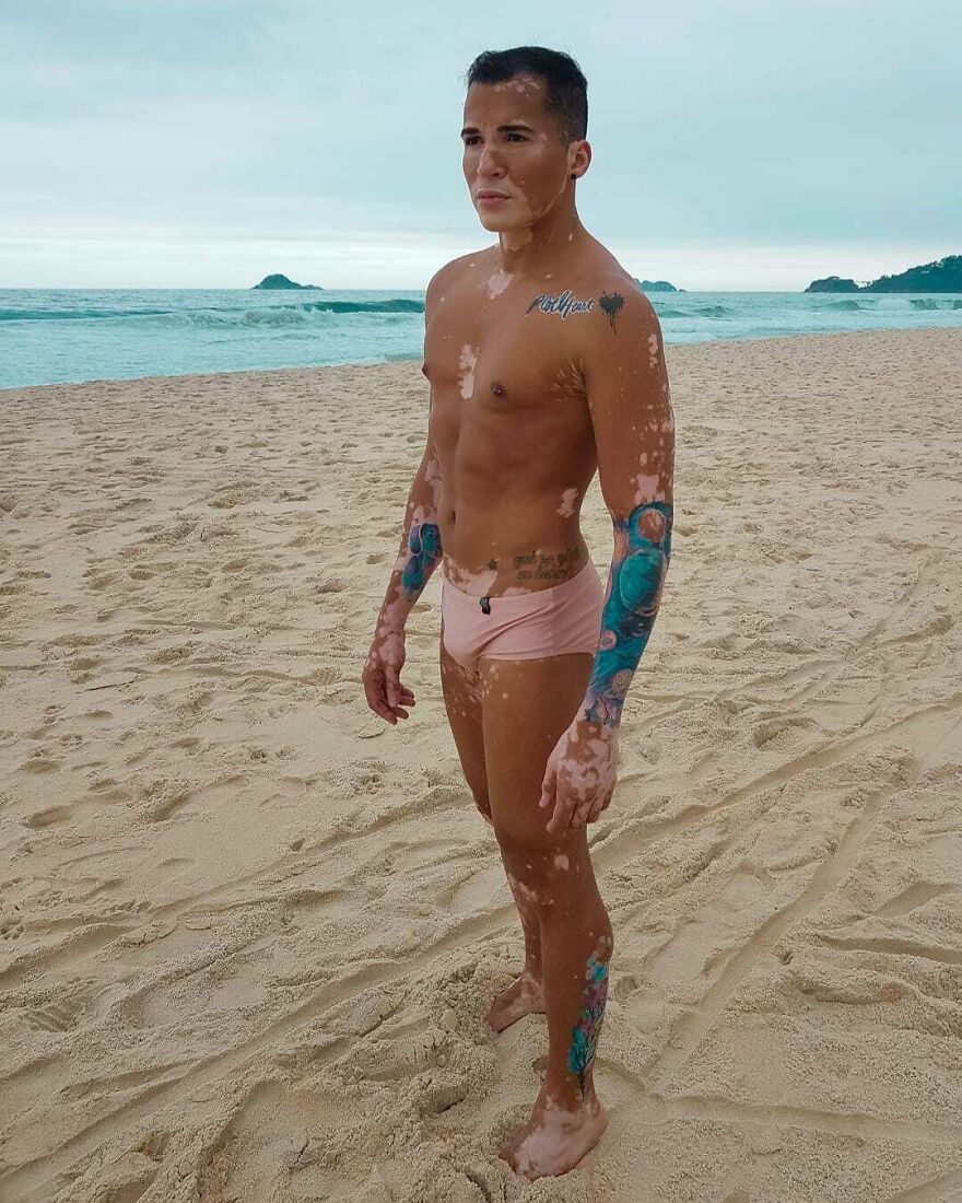 After Battling Depression For A Decade, This Brazilian Model With Vitiligo Learnt To Accept Himself After Battling Depression For A Decade, This Brazilian Model With Vitiligo Learnt To Accept Himself