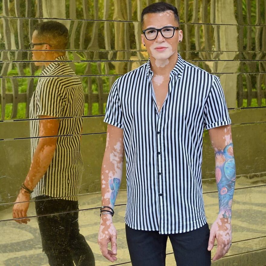 After Battling Depression For A Decade, This Brazilian Model With Vitiligo Learnt To Accept Himself After Battling Depression For A Decade, This Brazilian Model With Vitiligo Learnt To Accept Himself