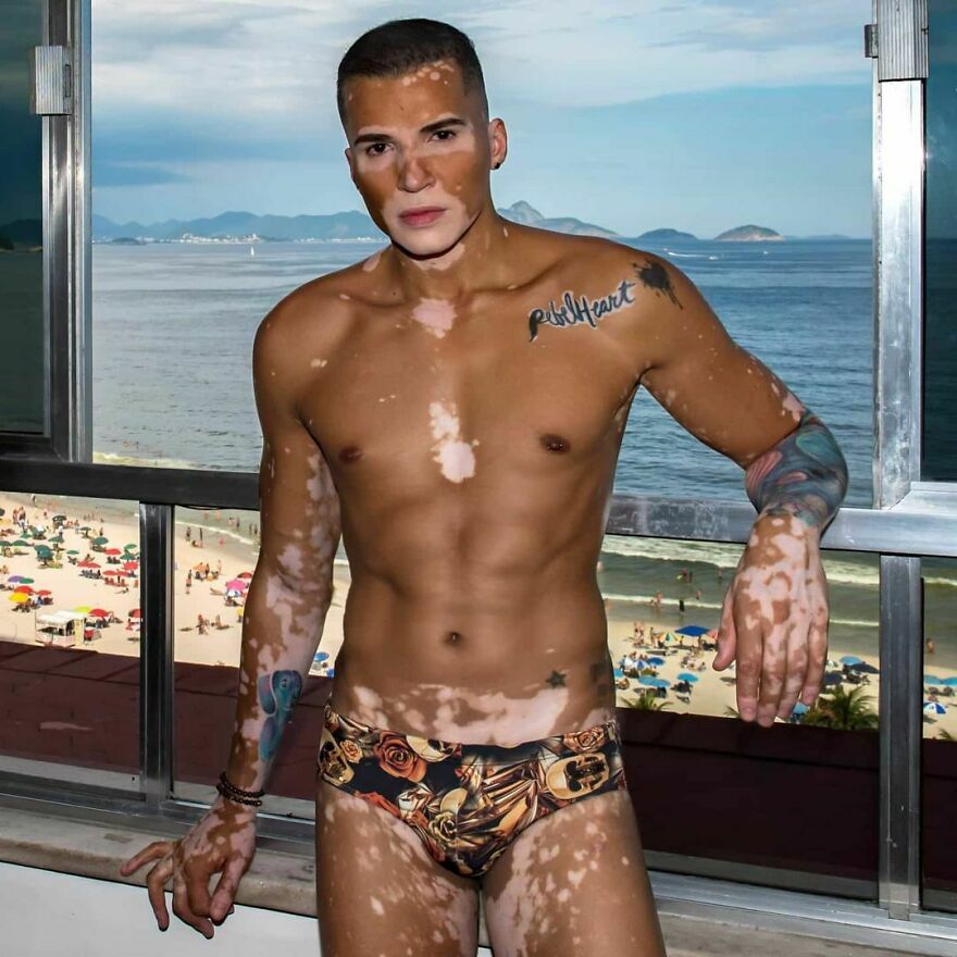 After Battling Depression For A Decade, This Brazilian Model With Vitiligo Learnt To Accept Himself