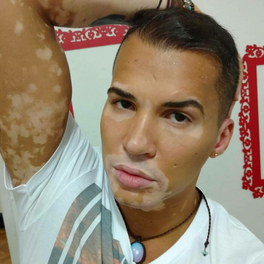 After Battling Depression For A Decade, This Brazilian Model With Vitiligo Learnt To Accept Himself