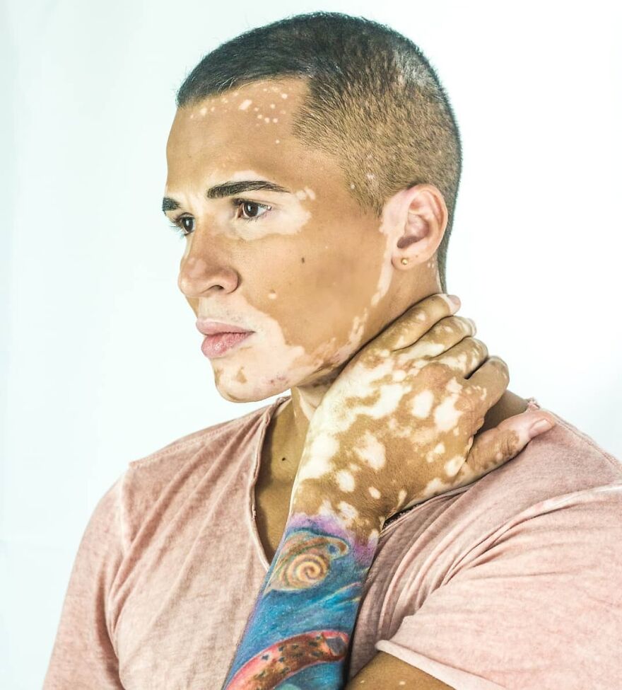 After Battling Depression For A Decade, This Brazilian Model With Vitiligo Learnt To Accept Himself