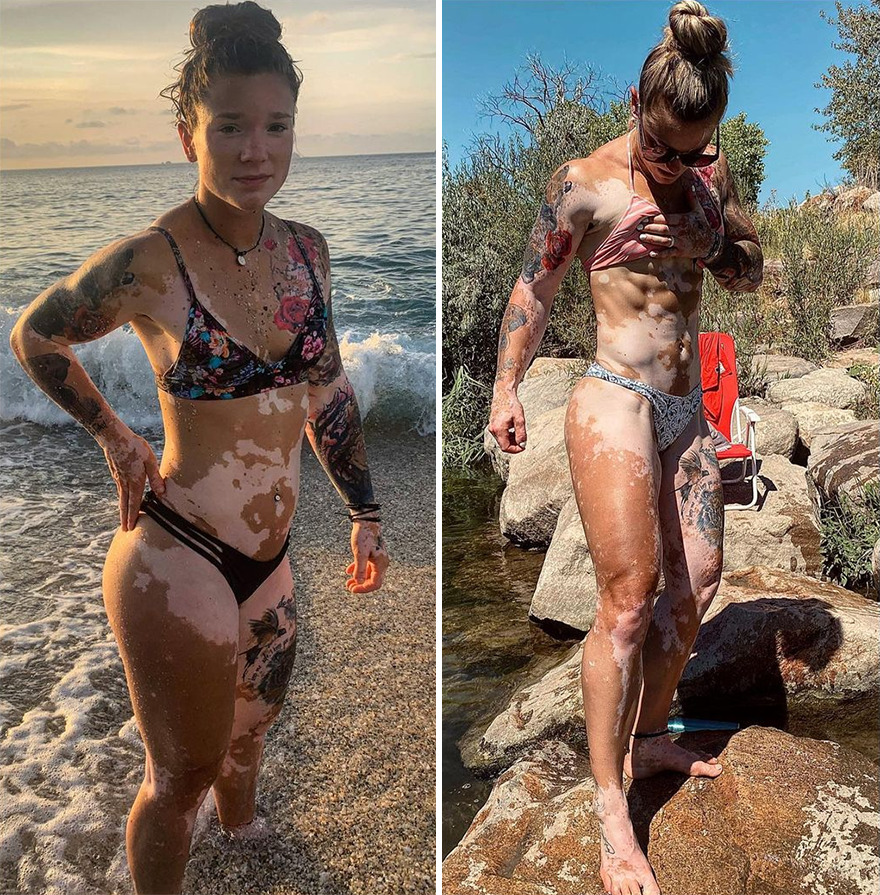 This Woman From Utah Learned To Accept Her Vitiligo Through Fitness And Weightlifting This Woman From Utah Learned To Accept Her Vitiligo Through Fitness And Weightlifting