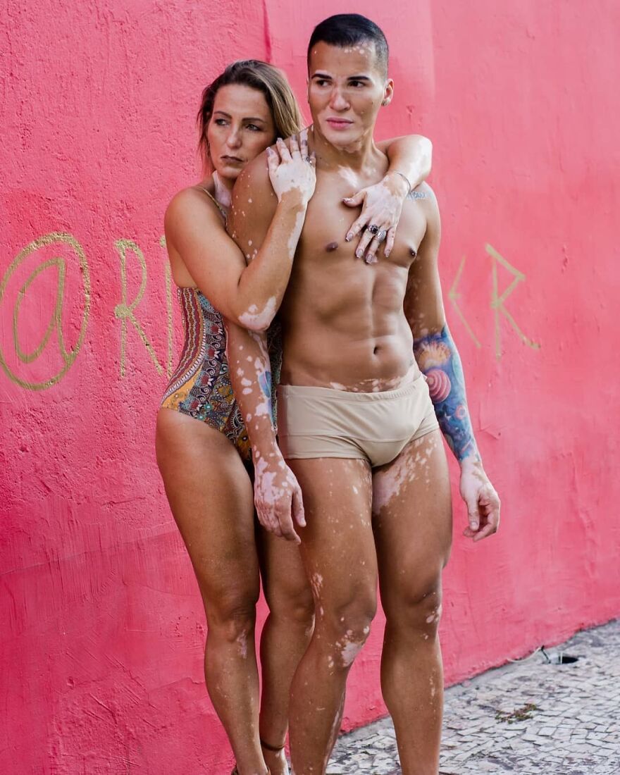 After Battling Depression For A Decade, This Brazilian Model With Vitiligo Learnt To Accept Himself After Battling Depression For A Decade, This Brazilian Model With Vitiligo Learnt To Accept Himself