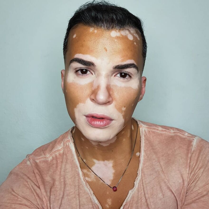 After Battling Depression For A Decade, This Brazilian Model With Vitiligo Learnt To Accept Himself After Battling Depression For A Decade, This Brazilian Model With Vitiligo Learnt To Accept Himself