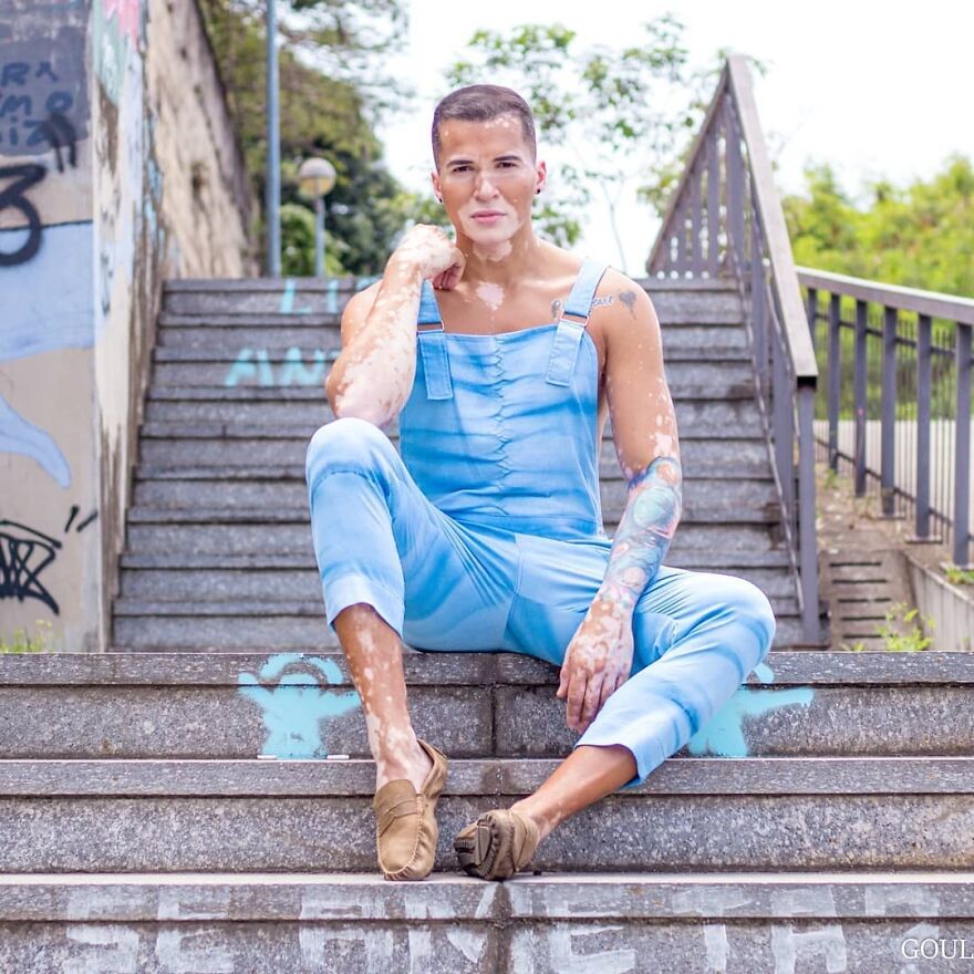 After Battling Depression For A Decade, This Brazilian Model With Vitiligo Learnt To Accept Himself