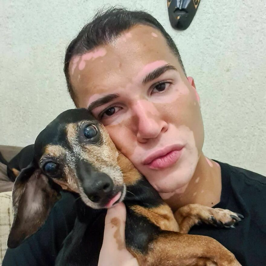 After Battling Depression For A Decade, This Brazilian Model With Vitiligo Learnt To Accept Himself After Battling Depression For A Decade, This Brazilian Model With Vitiligo Learnt To Accept Himself