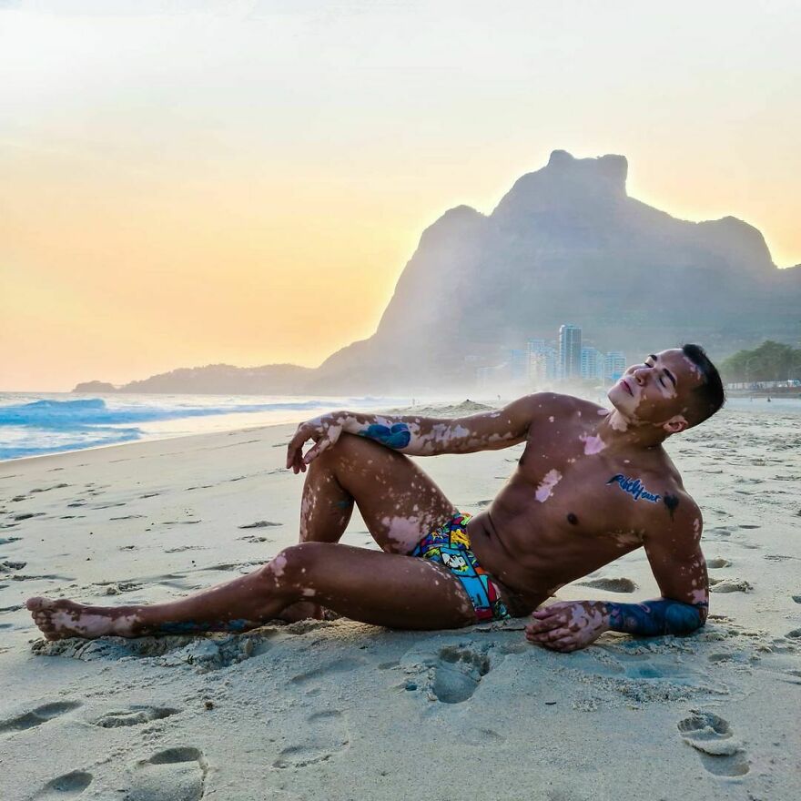 After Battling Depression For A Decade, This Brazilian Model With Vitiligo Learnt To Accept Himself After Battling Depression For A Decade, This Brazilian Model With Vitiligo Learnt To Accept Himself