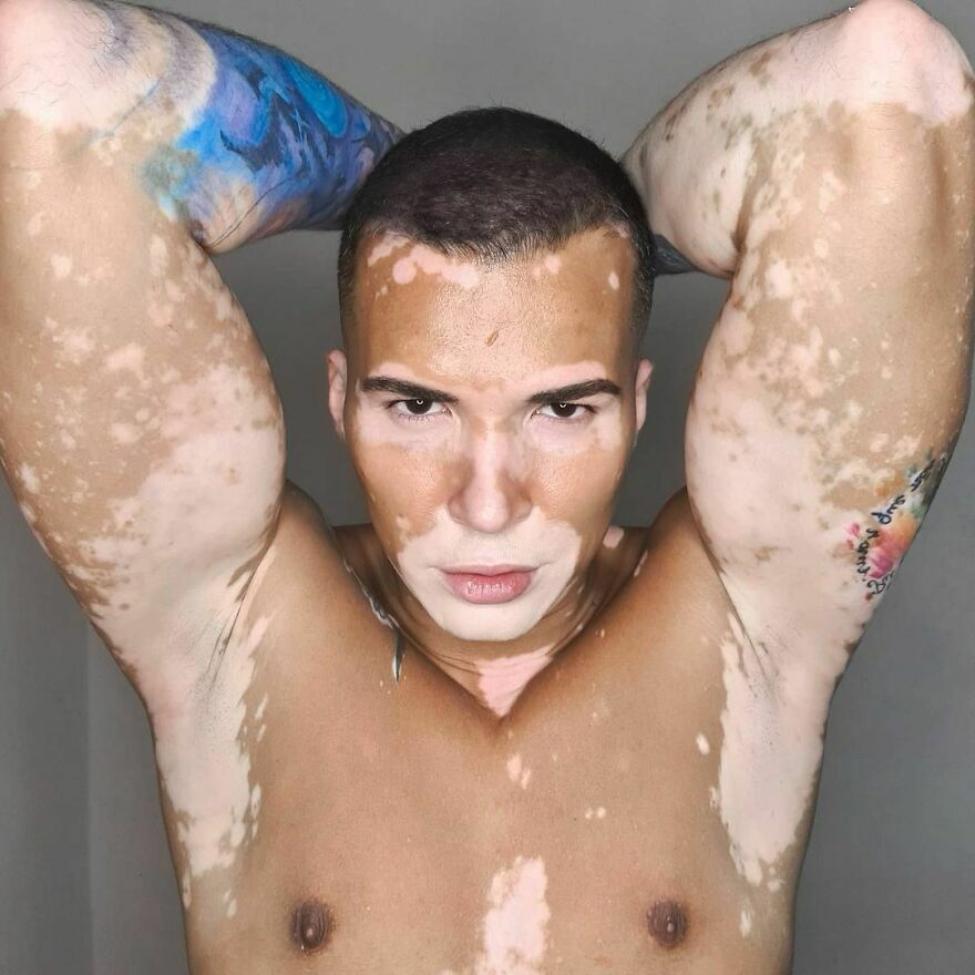 After Battling Depression For A Decade, This Brazilian Model With Vitiligo Learnt To Accept Himself After Battling Depression For A Decade, This Brazilian Model With Vitiligo Learnt To Accept Himself