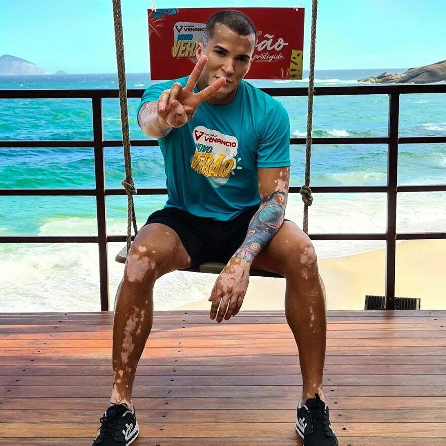 After Battling Depression For A Decade, This Brazilian Model With Vitiligo Learnt To Accept Himself After Battling Depression For A Decade, This Brazilian Model With Vitiligo Learnt To Accept Himself