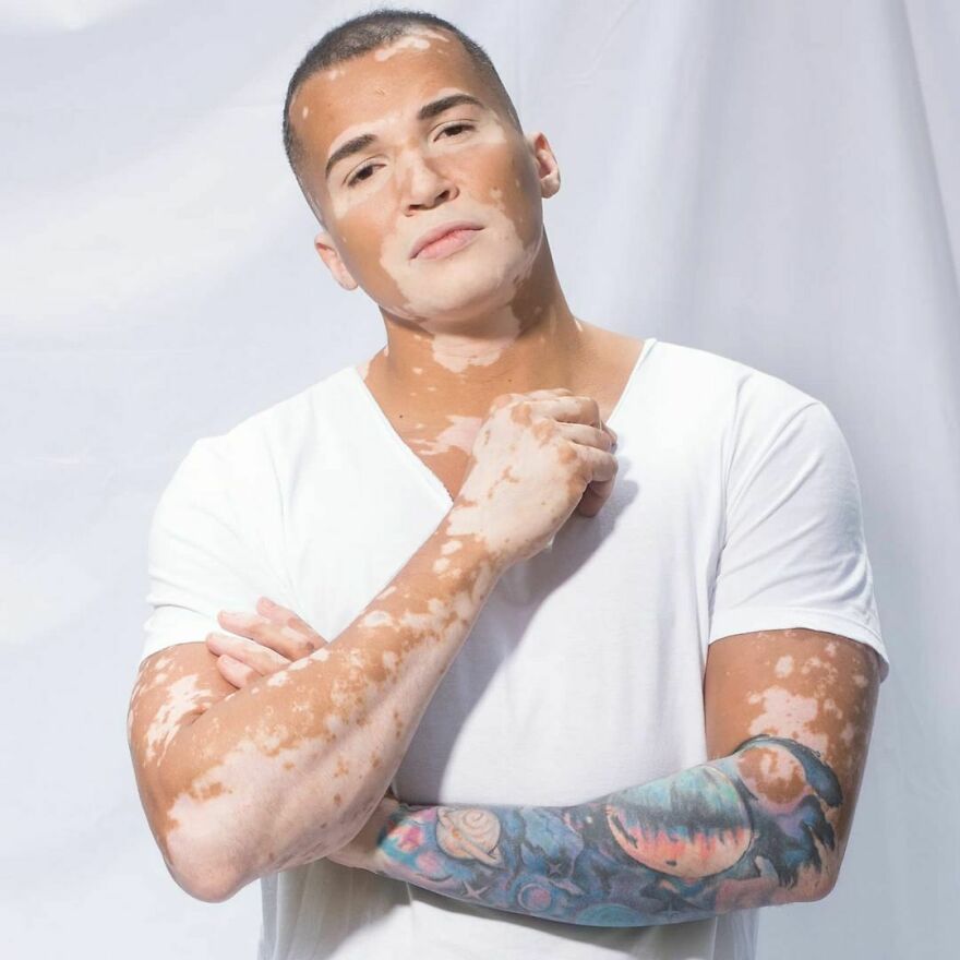 After Battling Depression For A Decade, This Brazilian Model With Vitiligo Learnt To Accept Himself After Battling Depression For A Decade, This Brazilian Model With Vitiligo Learnt To Accept Himself