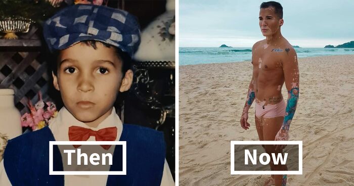 After Battling Depression For A Decade, This Brazilian Model With Vitiligo Learnt To Accept Himself