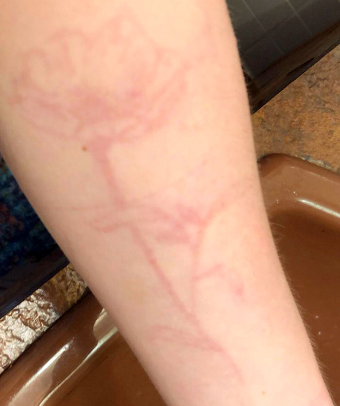 This Flower “Scar” I Was Left With After Having An Allergic Reaction To Henna