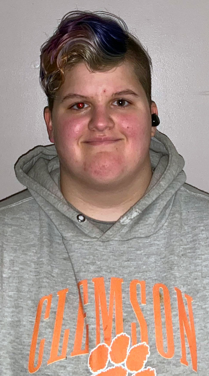 I’m Partially Blind In My Left Eye. It Doesn’t Show Any “Red-Eye” In Photos