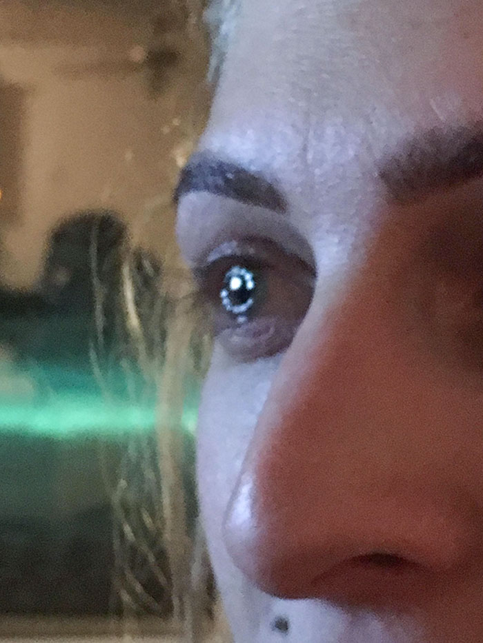 I Had 16 Clear Stitches On My Eyeball From A Cornea Transplant When This Pic Was Taken And The Way The Light Hits It You Can See Each One