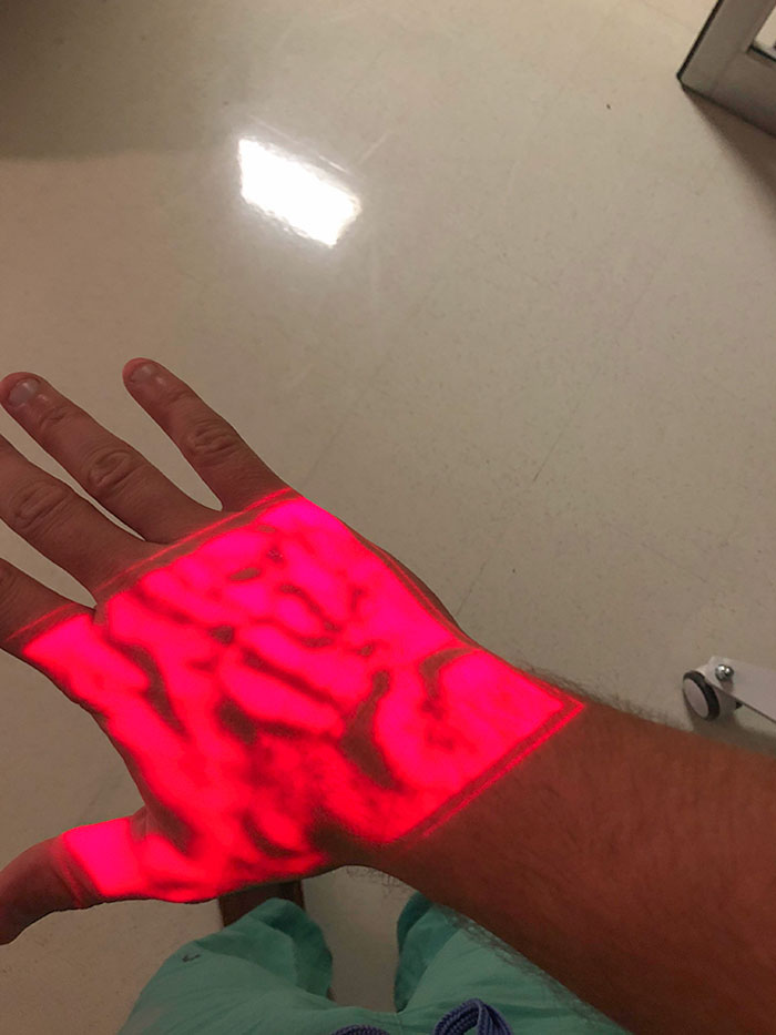 My Veins Under A Hospital Vein Finder