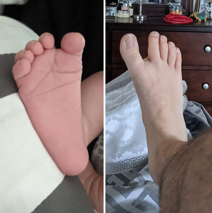 My Wife Just Gave Birth To Our Firstborn, And Me And My Son Both Have The Same Weird Genetic Abnormality Where We Have An Extra Large Space Between Our First And Second Toes
