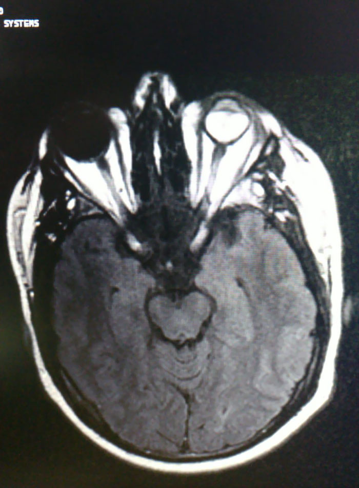 My Husband’s MRI Scan Shows His Blind Left Eye As Fully Black