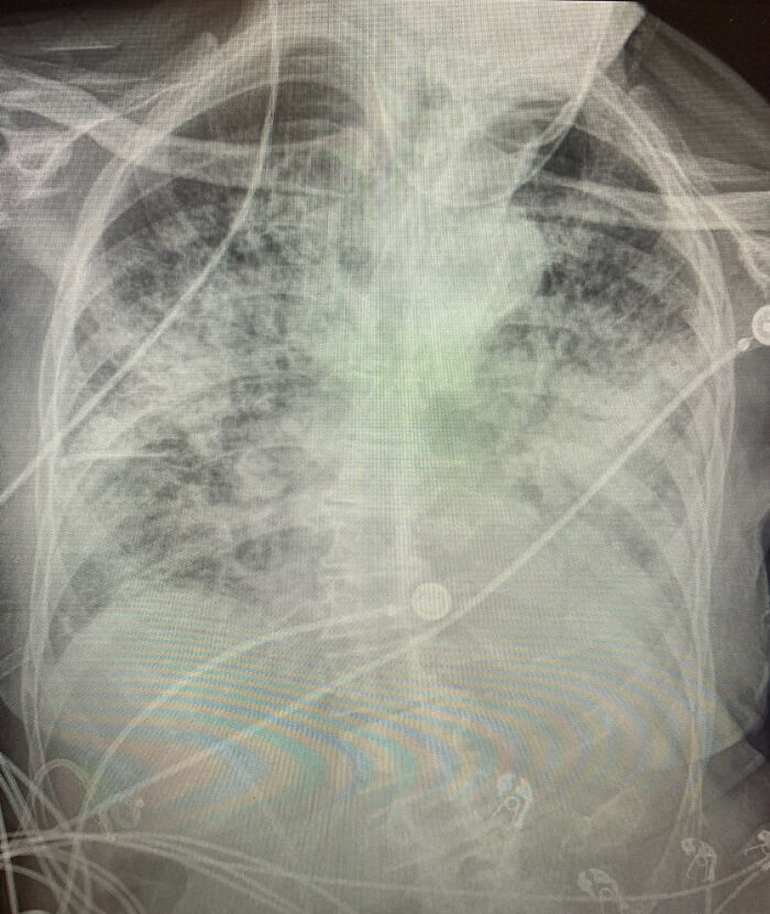 X-Ray Shows The Effect Of COVID-19 On The Lungs Compared To A Smoker's Lungs X-Ray Shows The Effect Of COVID-19 On The Lungs Compared To A Smoker's Lungs