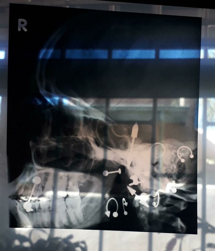 I Went For A Sinus X-Ray And They Said I Didn't Need To Takes Out All My Piercings, This Is What It Looked Like