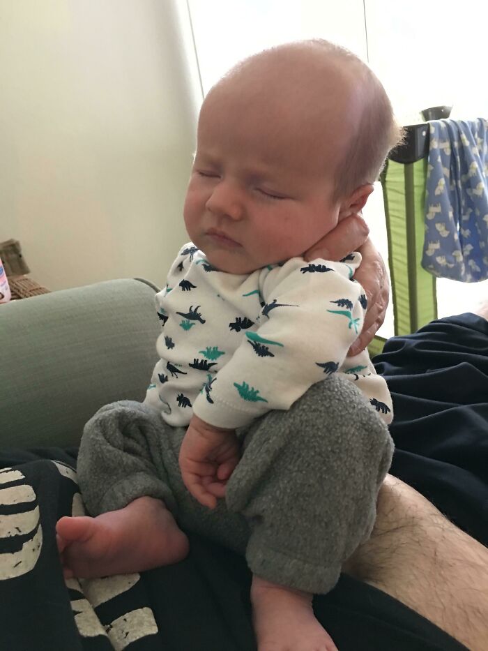 Receding Hairline At The Ripe Old Age Of 3 Weeks