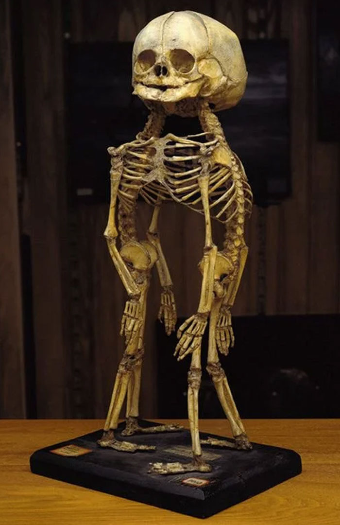 An Incredible Deformity Found At The Mütter Museum Of Medical Oddities In Philadelphia